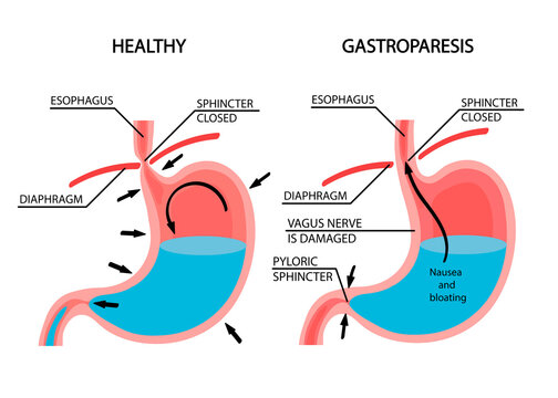 Visual Comparison Of Healthy Gastric And Stomach With Gastroparesis.