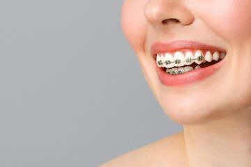 Orthodontic Treatment. Dental Care Concept. Beautiful Woman Healthy Smile close up. Closeup Ceramic and Metal Brackets on Teeth. Beautiful Female Smile with Braces.