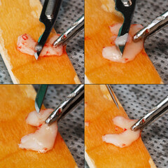 collage surgical work with flap dental implantation