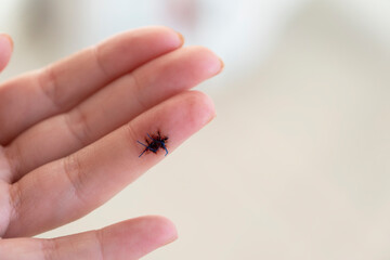 A wound on a woman's finger was treated with surgical sutures.