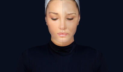 Plastic Surgery Results,Nasolabial folds,Neck ,Under eye circles,neck lines.