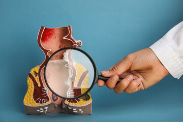 Proctologist holding magnifying glass near anatomical model of rectum with hemorrhoids on light blue background, closeup