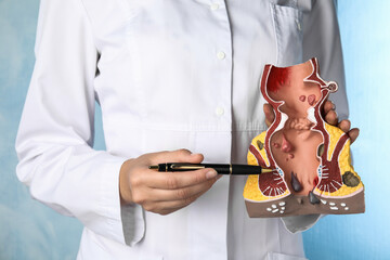 Doctor pointing at model of unhealthy lower rectum on light blue background, closeup. Hemorrhoid problem - obrazy, fototapety, plakaty