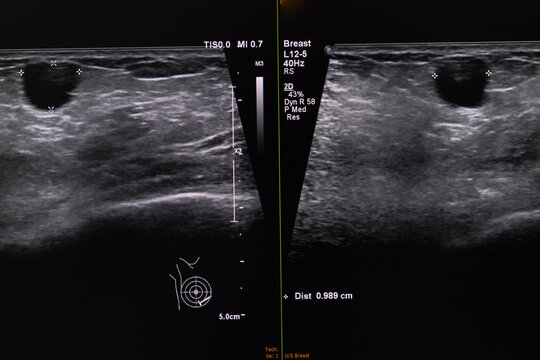 An ultrasound image of a female breast showing a large nodule in the breast tissue.