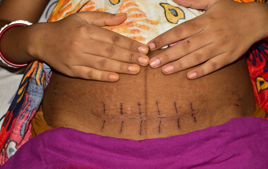 Close up of a scar on the belly created from Cesarean section or C-section or surgical delivery...