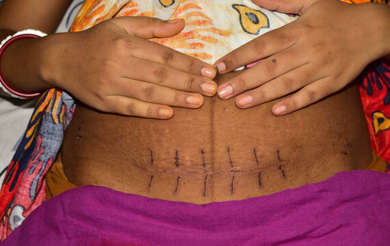 Photograph of the left corner of the cesarean section scar showing a