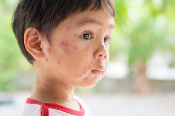 Portrait of sick little  boy. Varicella virus or Chickenpox bubble rash on child - obrazy, fototapety, plakaty
