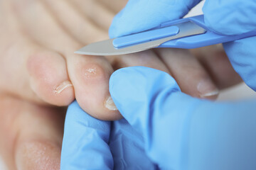 Fototapeta premium Doctor surgeon in rubber glove removing dry callus on toe with scalpel closeup