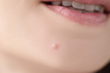 Closeup of white pimple on chin skin of young woman