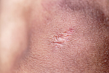Fototapeta premium Close up of cyanotic keloid scar caused by surgery and suturing 