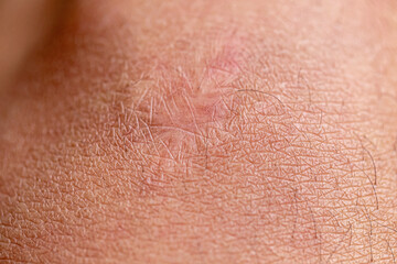 Fototapeta premium Close up of cyanotic keloid scar caused by surgery and suturing 