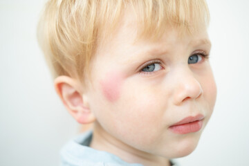portrait of little Boy with allergic red spot at face cause by mosquito bite