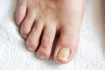 Details of man nails with fungal infection known as mycosis, natural light