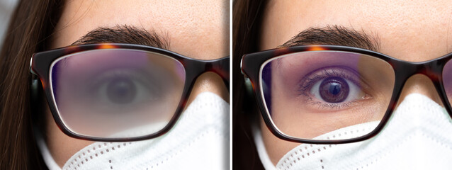 girl with fogged glasses showing the comparison between before and after anti-fog treatment of the...