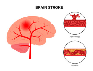 Brain stroke ishemic and hemorrhagic - obrazy, fototapety, plakaty