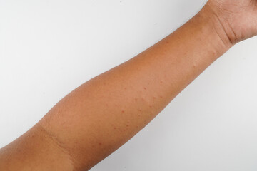 men hands get mosquito bites