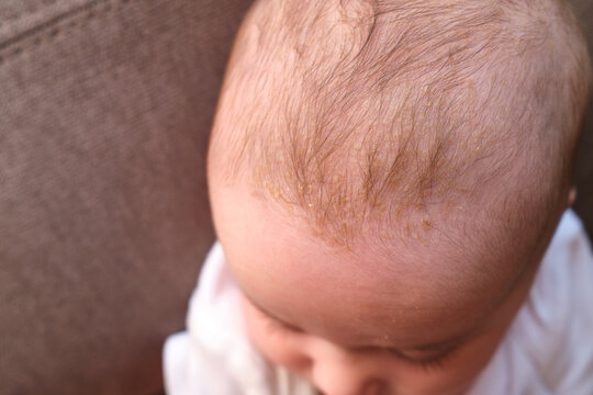 Cradle cap (seborrheic dermatitis) on the head of babies