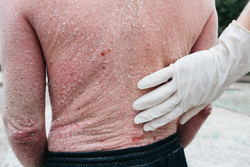 Doctor examining patient with psoriasis on back, closeup. Outdoor