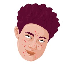 Nonbinary Person with white skin and purple hair. They have a lot of acne pimpels. 