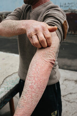 The man scratches his hands covered with psoriasis, which itch very much and his joints hurt, the concept of psoriasis, eczema and other diseases of dry skin. Skin problem