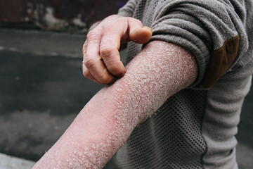 The man scratches his hands covered with psoriasis, which itch very much and his joints hurt, the concept of psoriasis, eczema and other diseases of dry skin. Skin problem