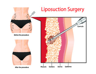 Liposuction. The operation to clean the fat layer under the skin.