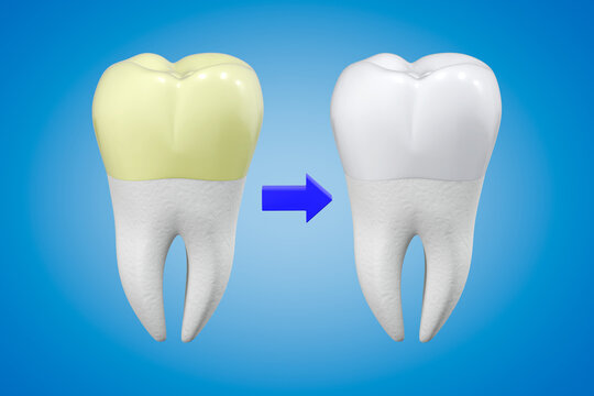 Tooth whitening concept. A tooth with yellow plaque and a white tooth with shiny enamel in comparison. Dental theme. 3d rendering.
