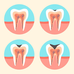 Stages of tooth caries in flat design. Tooth decay concept. Dental illness. 