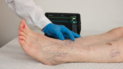 elderly patient at the doctor who checks her legs with many varicose veins