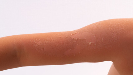 skin after sunburn. skin slips