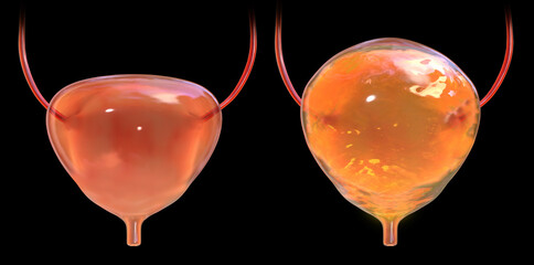 Urinary bladder empty and full, 3D illustration - obrazy, fototapety, plakaty