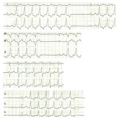 Self-limited ventricular tachycardia. Life-threatening arrhythmia. Electrocardiogram with ventricular cardiac arrhythmia.
