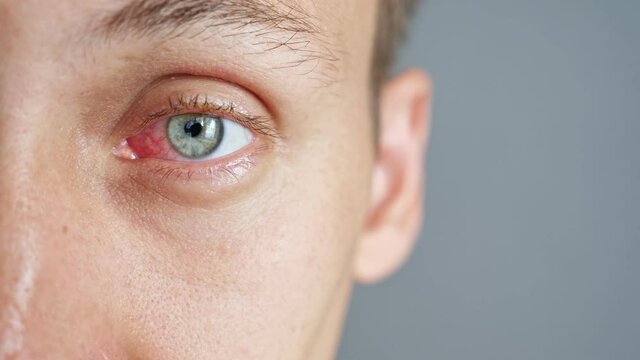 Close-up of the red eye of a man affected by an infection.