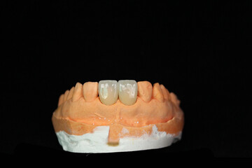 Dental crowns and veneers in the plaster model