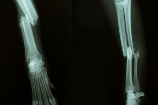 X-ray from broken foreleg (ulna and radius) of a dog. Front view (left) and Side view (right)