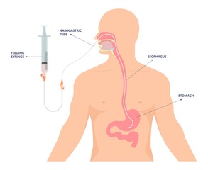 TPN PPN Total tube nutritional partial line PICC IV care unit ICU tract enteral gavage nose PEG stomach surgery system small nose large food cancer eat NG bowel PEJ pump