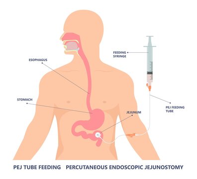 TPN PPN Total tube nutritional partial line PICC IV care unit ICU tract enteral gavage nose PEG stomach surgery system small nose large food cancer eat NG bowel PEJ pump
