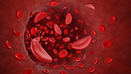 Sickle cells in bloodstream - obrazy, fototapety, plakaty