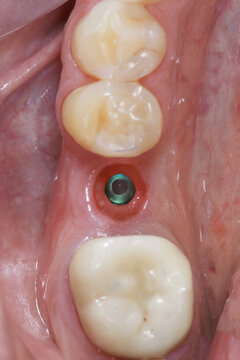 hole in the gum before installing the dental crown of the chewing tooth