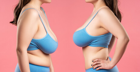 Before and after breast augmentation concept, woman with very large silicone breasts after correction surgery - obrazy, fototapety, plakaty