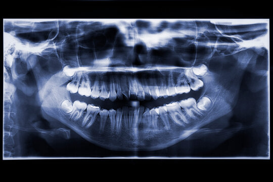 closeup of patient dental x-ray image