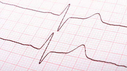cardiogram of heart impulses, hypertonic disease concept