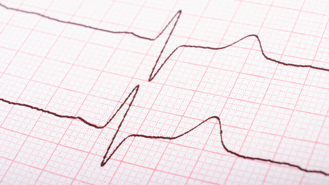 cardiogram of heart impulses, hypertonic disease concept