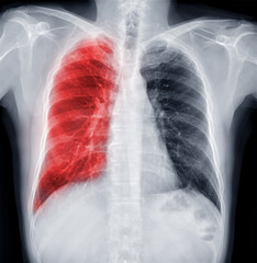 Chest X-ray Of Human Chest or Lung  for detect tuberculosis