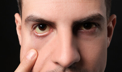 Obraz premium Man checking his health condition on black background, closeup. Yellow eyes as symptom of problems with liver
