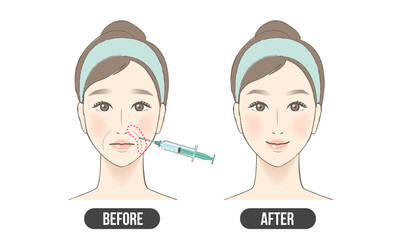 ほうれい線　治療（カラー）