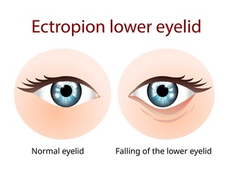 Ectropion Lower eyelid, Ectropion is a condition in which your eyelid turns outward - obrazy, fototapety, plakaty