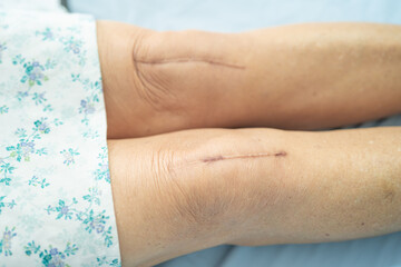 Asian senior or elderly old lady woman patient show her scars surgical total knee joint replacement Suture wound surgery arthroplasty on bed in nursing hospital ward, healthy strong medical concept.