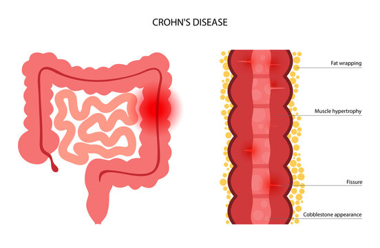 Chrons disease concept