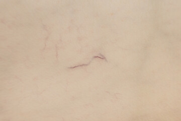 telangiectasia close-up.  cosmetic skin defect. 
